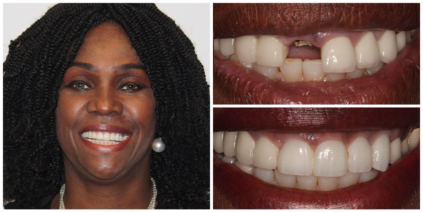 Elite Smiles Patient Before and After