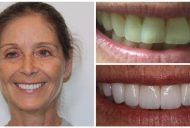 Elite Smiles Patient Before and After